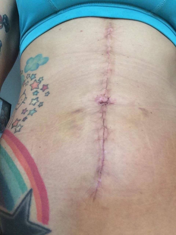 15966437_398458957167661_120615393_o - Varför vi måste prata mer om magdelning efter graviditet