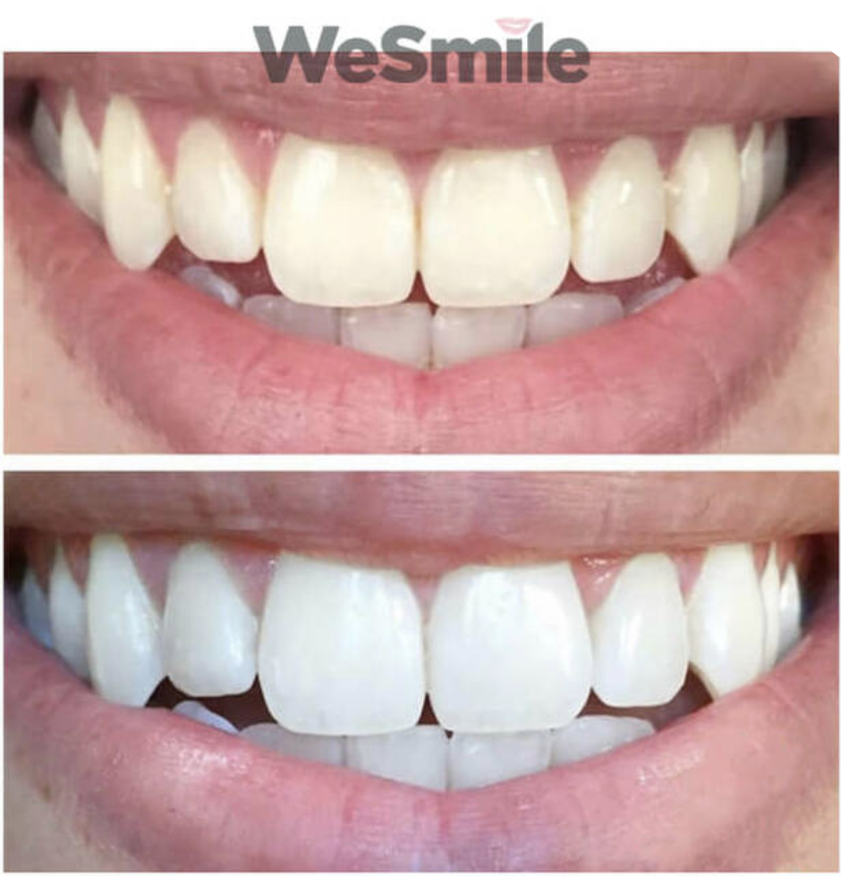 Skärmavbild-2021-10-07-kl.-11.34.15 - Skonsam tandblekning