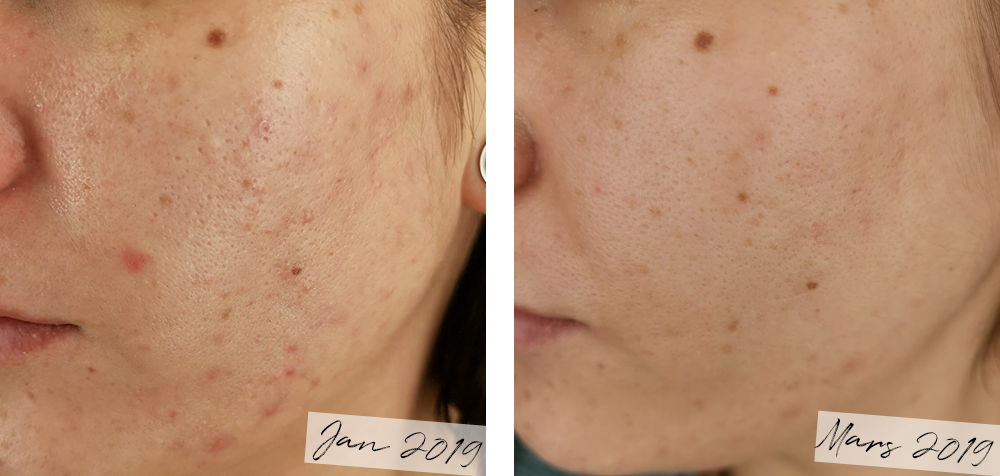 cool derma före och efter