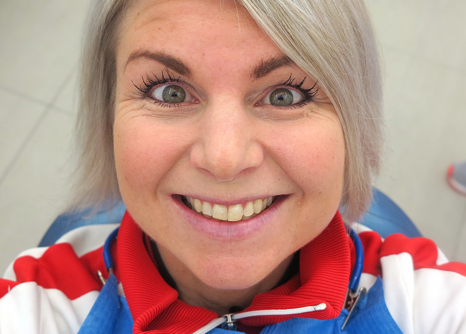 fore_tandblekning - tandblekning