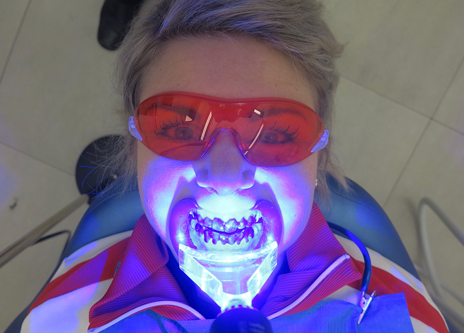 tandblekning_2 - tandblekning