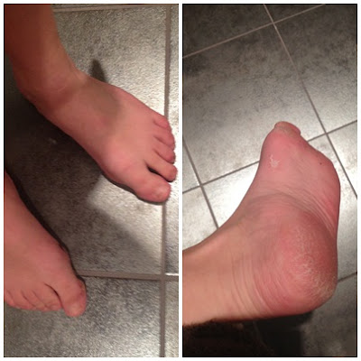 Babyfoot-efter - Babyfoot